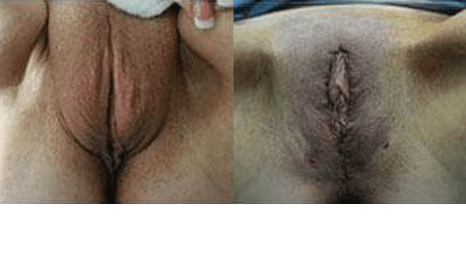 Before and after image of labiaplasty surgery results.