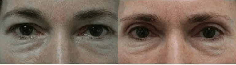 Before and after image showing results of eyelid surgery.