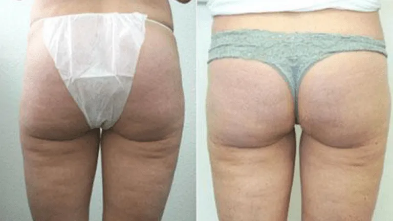 Before and after images of buttock enhancement surgery.