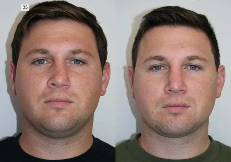 Before and after plastic surgery male patient front view.