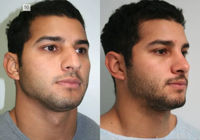 Before and after rhinoplasty patient photos.