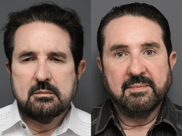 Before and after images of a man showing facial transformation post-plastic surgery.