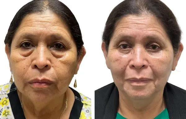 Before and after images of a woman post-facial rejuvenation surgery.
