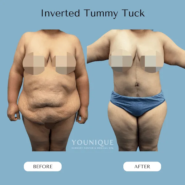 Before and after inverted tummy tuck results on a patient.