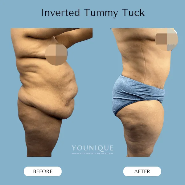 Before and after results of an inverted tummy tuck procedure.