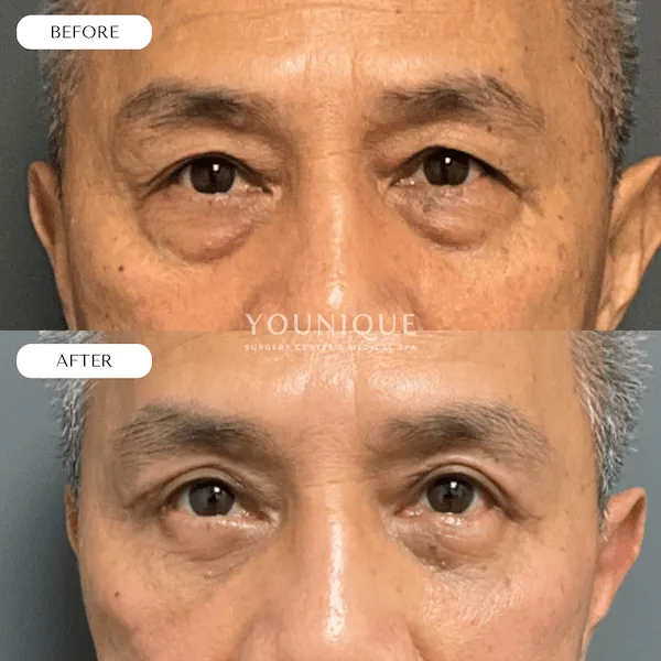 Before and after eye surgery comparison showcasing reduced under-eye bags.