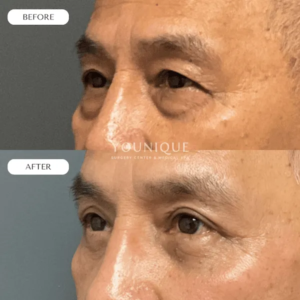 Before and after eyelid surgery results on a man's eyes.