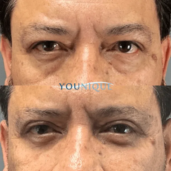 Before and after results of eyelid surgery showing reduced puffiness and smoother skin around the eyes.
