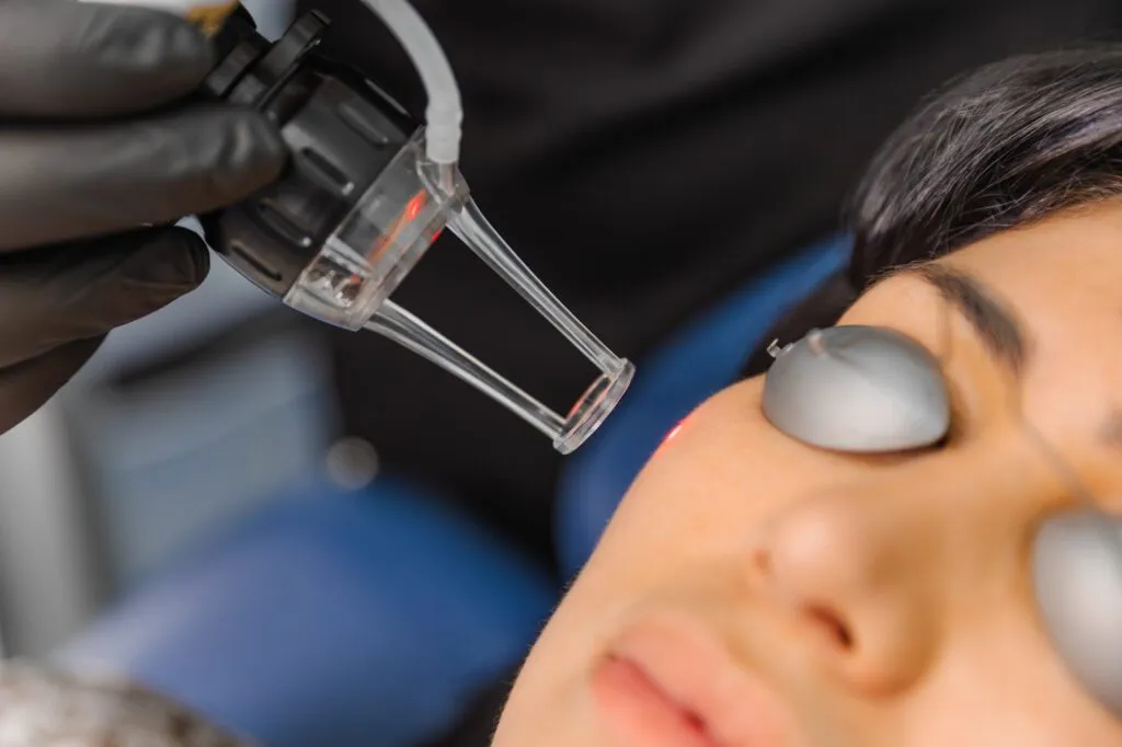 Laser skin treatment being performed on a woman's face.