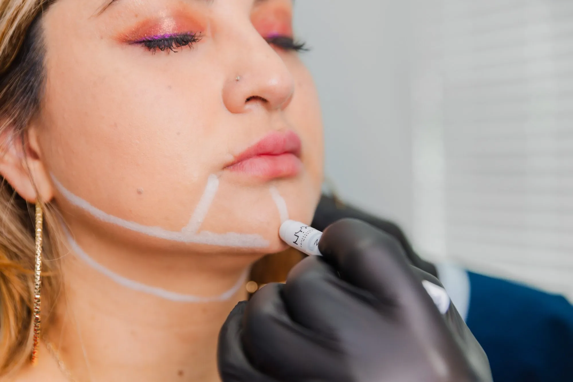 Person's chin being marked with white lines during a plastic surgery consultation.
