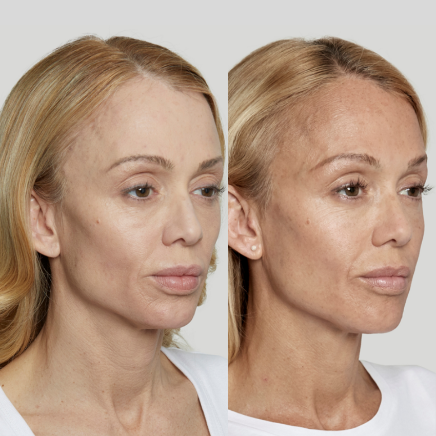 Sculptra Before and After