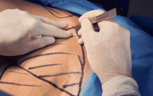 patient undergoing cosmetic surgery in Santa Monica